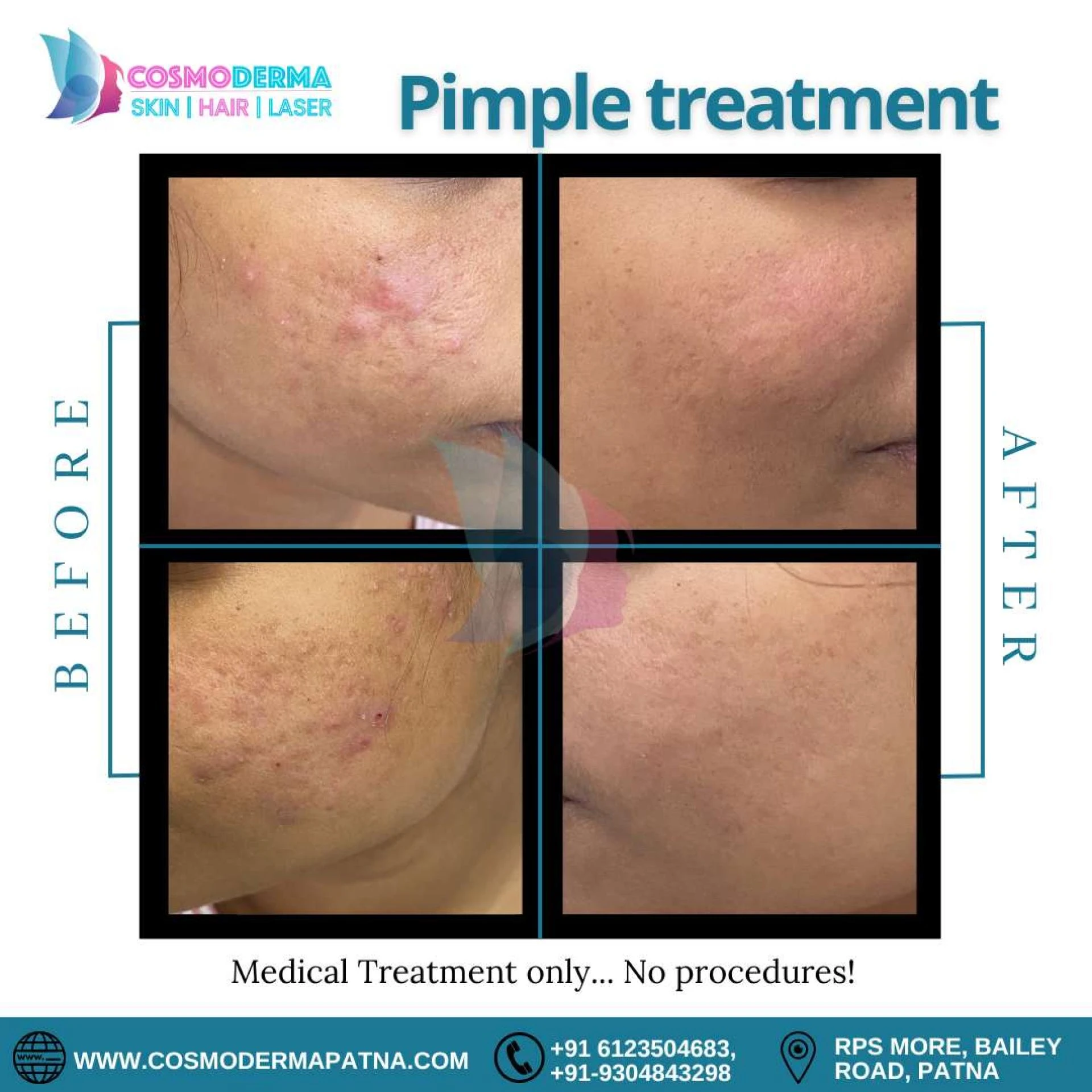 Say Goodbye to Pesky Acne: Effective Acne &amp; Acne Scar Treatment for Clear, Healthy Skin!