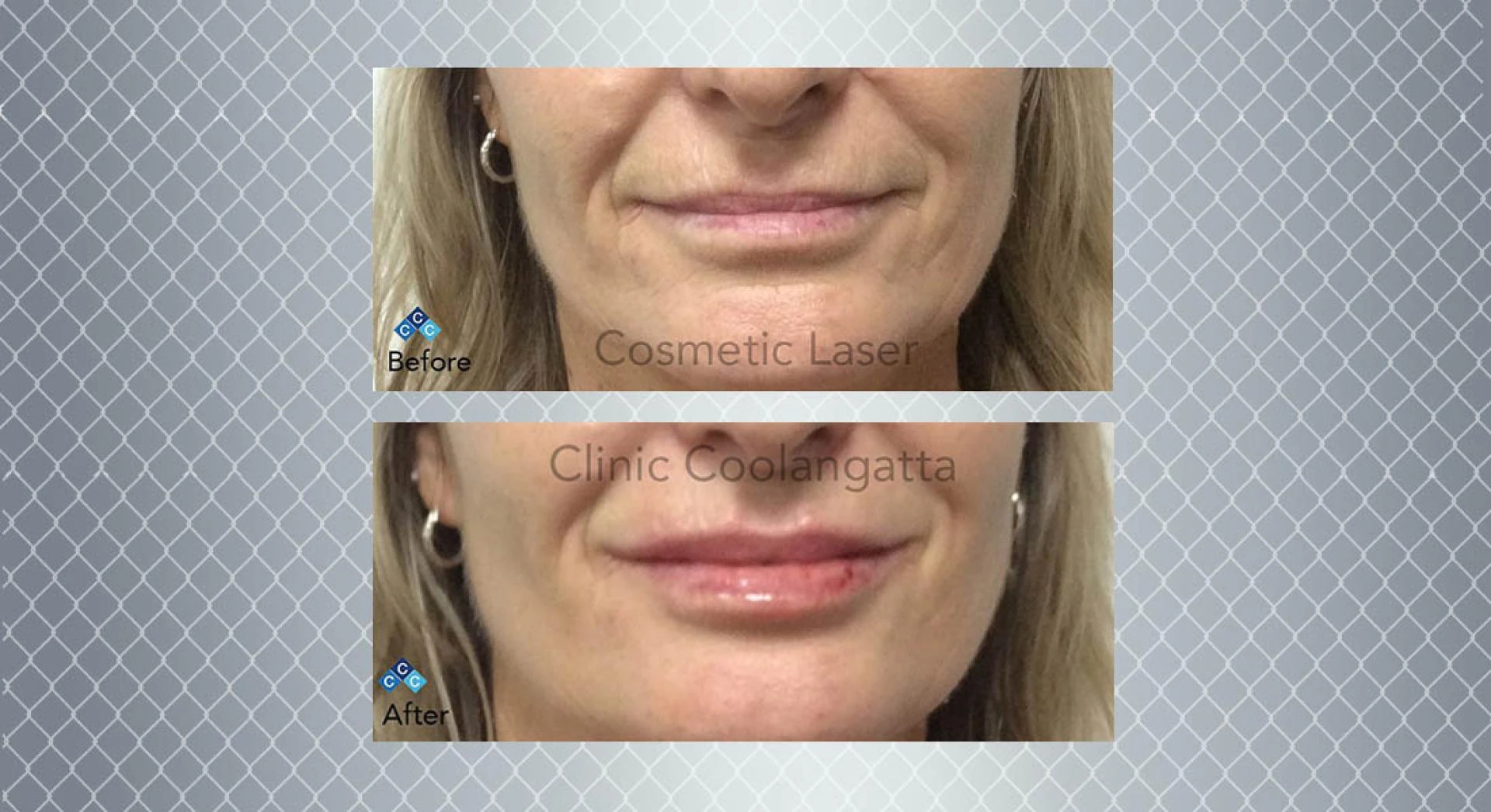 What is in a Dermal Filler?