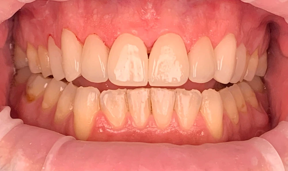 Secure Missing Teeth Replacements | Dental Implants Dentures