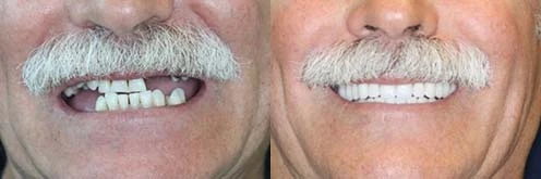 Secure Missing Teeth Replacements | Dental Implants Dentures