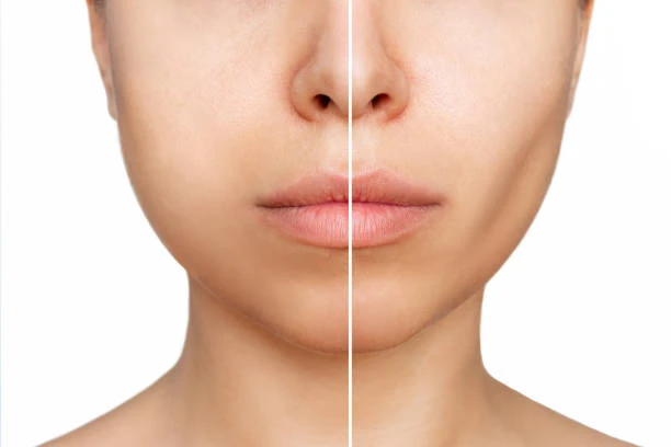 Transform Your Profile: Buccal Fat Removal in Abu Dhabi