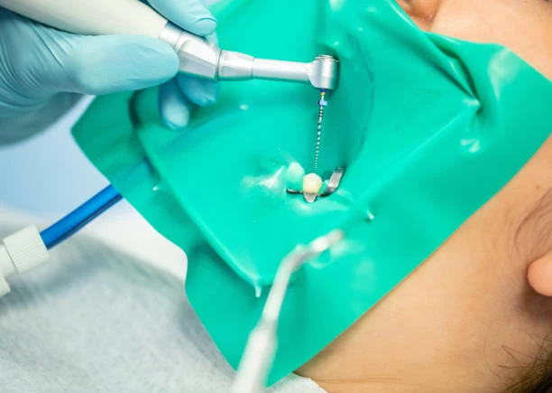 Demystifying Root Canal Treatment Cost in Abu Dhabi: Price Breakdown