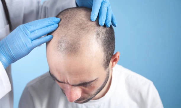 Transform Your Appearance: Hair Transplant in Abu Dhabi