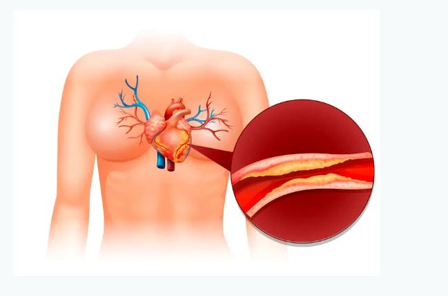 5 Strategies To Lower Your Cholesterol Level With Food And Exercise