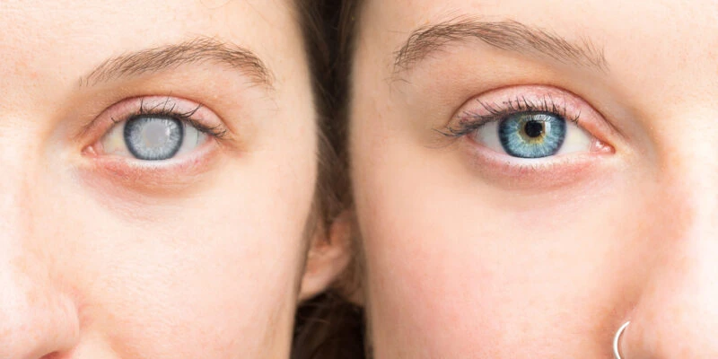 Laser Treatment for Cataract