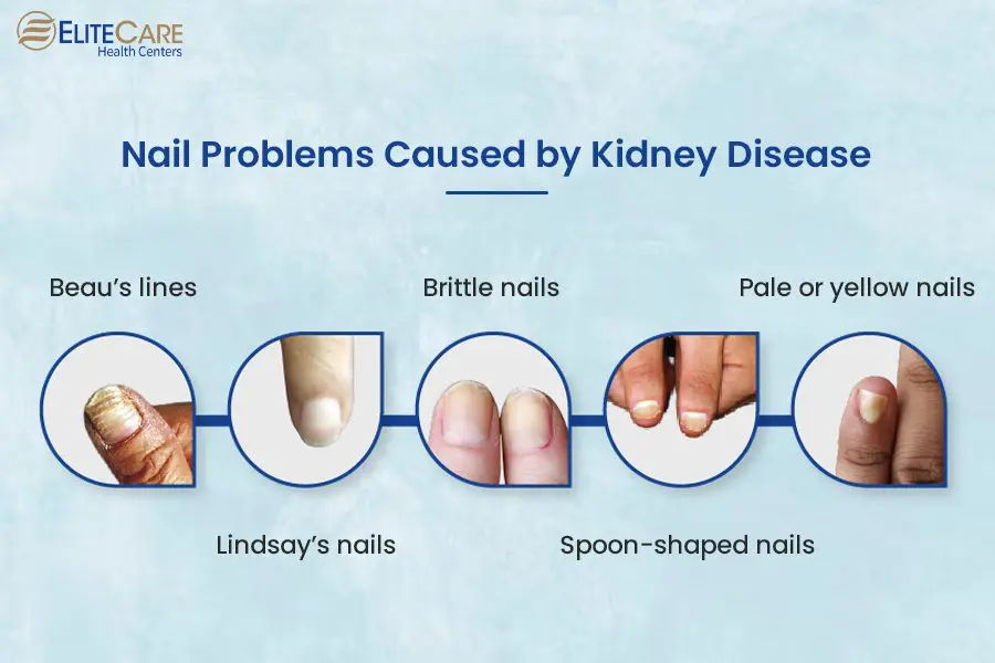 Unlocking Clues: What Your Nails Can Tell You About Kidney Health