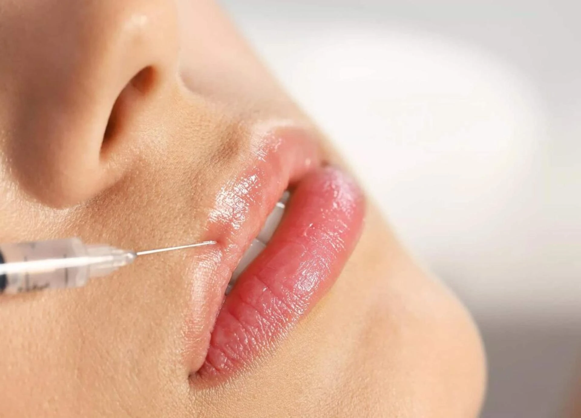 Where Can You Find Botox Lip Flip in Dubai