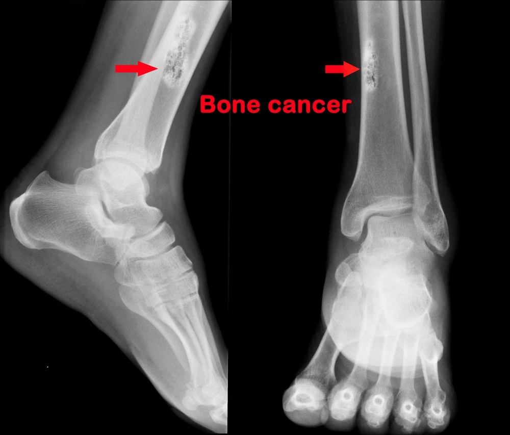 Bone Cancer Uncovered: Research Trends and Market Insights | DLI