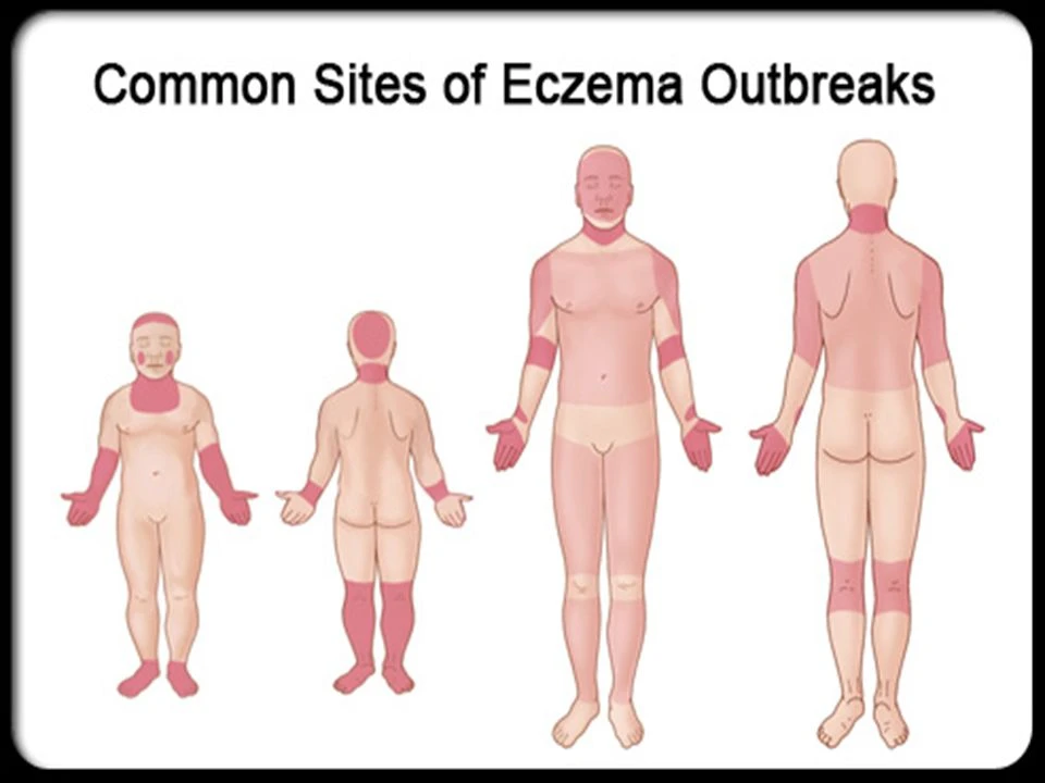 Strategic Solutions: DLI's Expertise in Atopic Eczema Market Entry