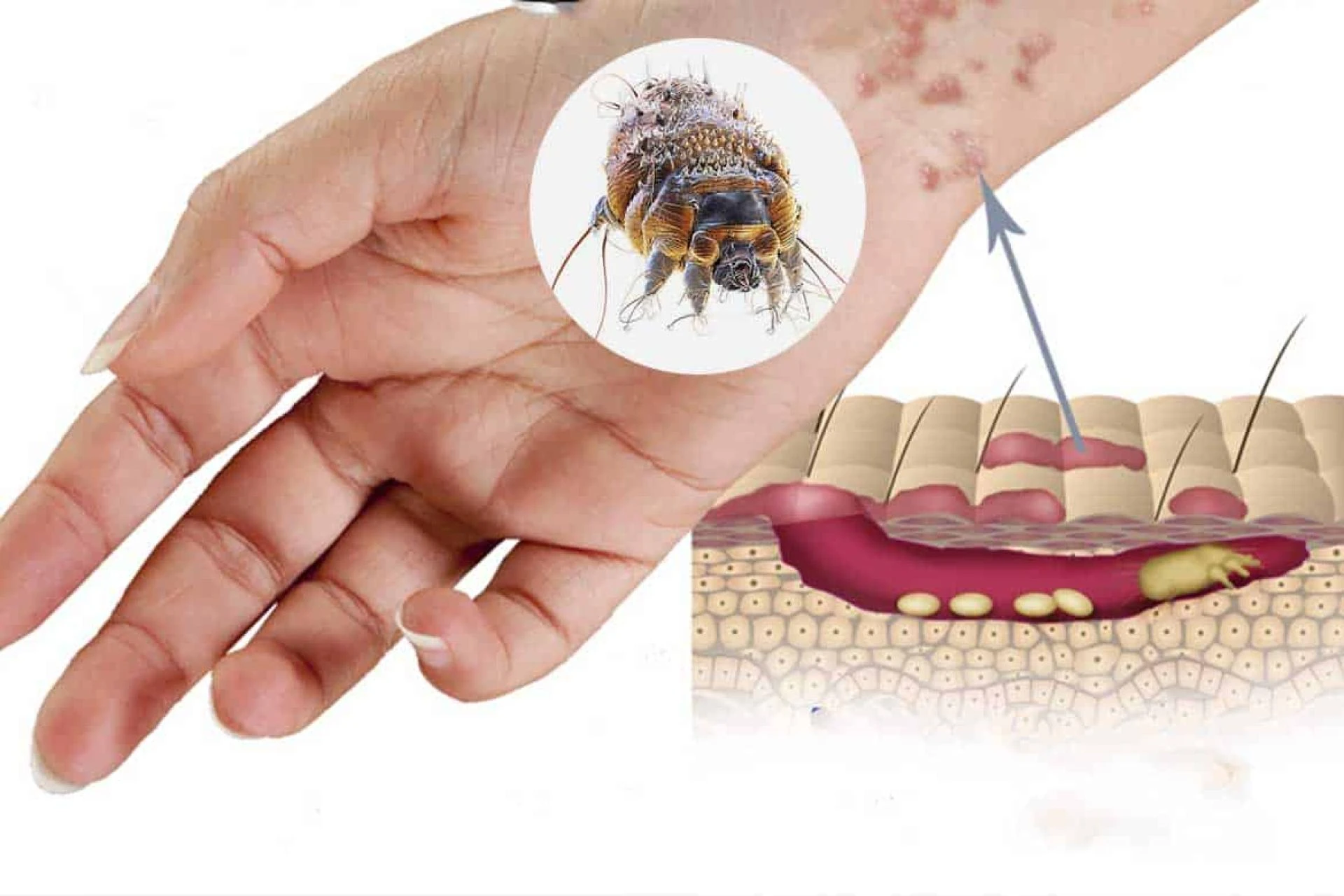 Market Entry Strategies Amidst Scabies: A Comprehensive Guide | DLI