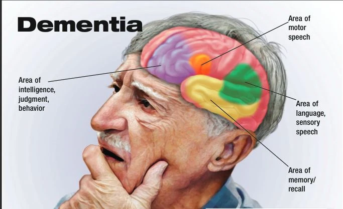 Expert Guidance for Frontotemporal Dementia: From Diagnosis to Treatment | DLI