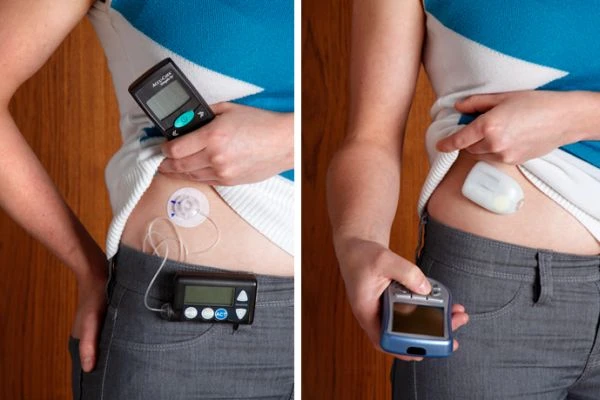 Insulin Delivery Devices the Invention of the Pen Device in 1985 Insulin Delivery Technology