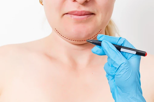 Everything You Need to Know About Kybella Injections: A Comprehensive Guide