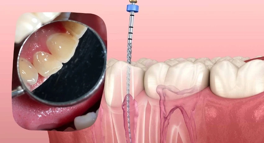 Common Myths About Root Canal Treatment Debunked