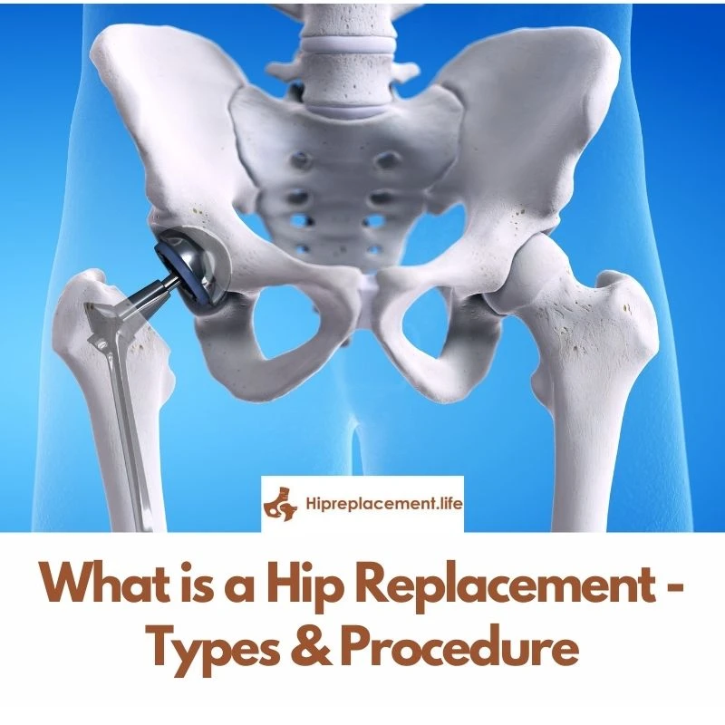 What is a Hip Replacement – Types &amp; Procedure