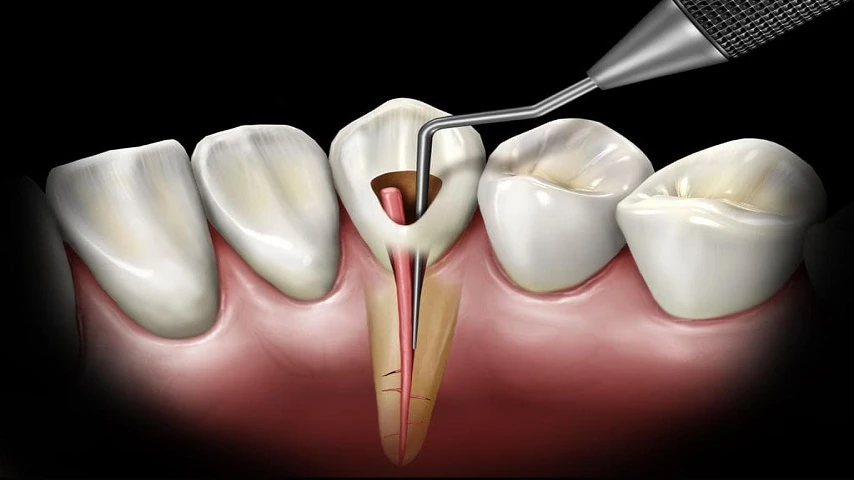 Everything You Should Know About Having A Root Canal