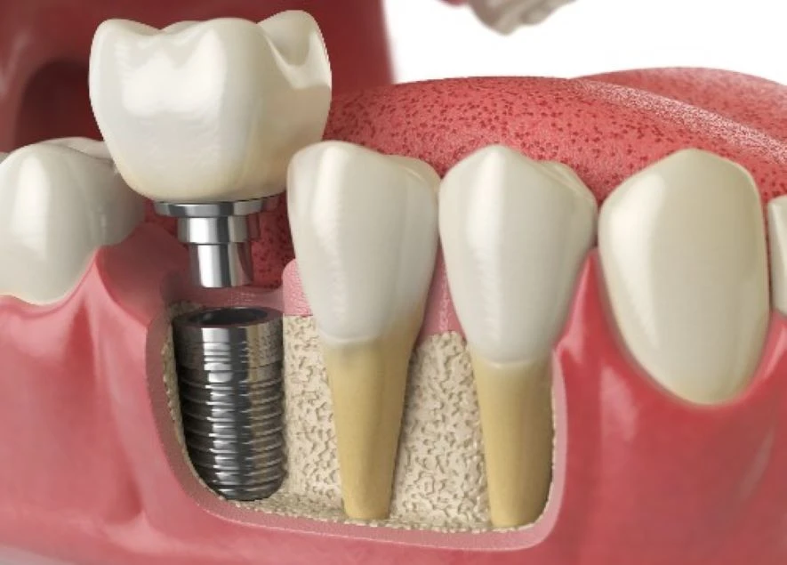 Replace Your Damaged Tooth Through a Dental Implant in London