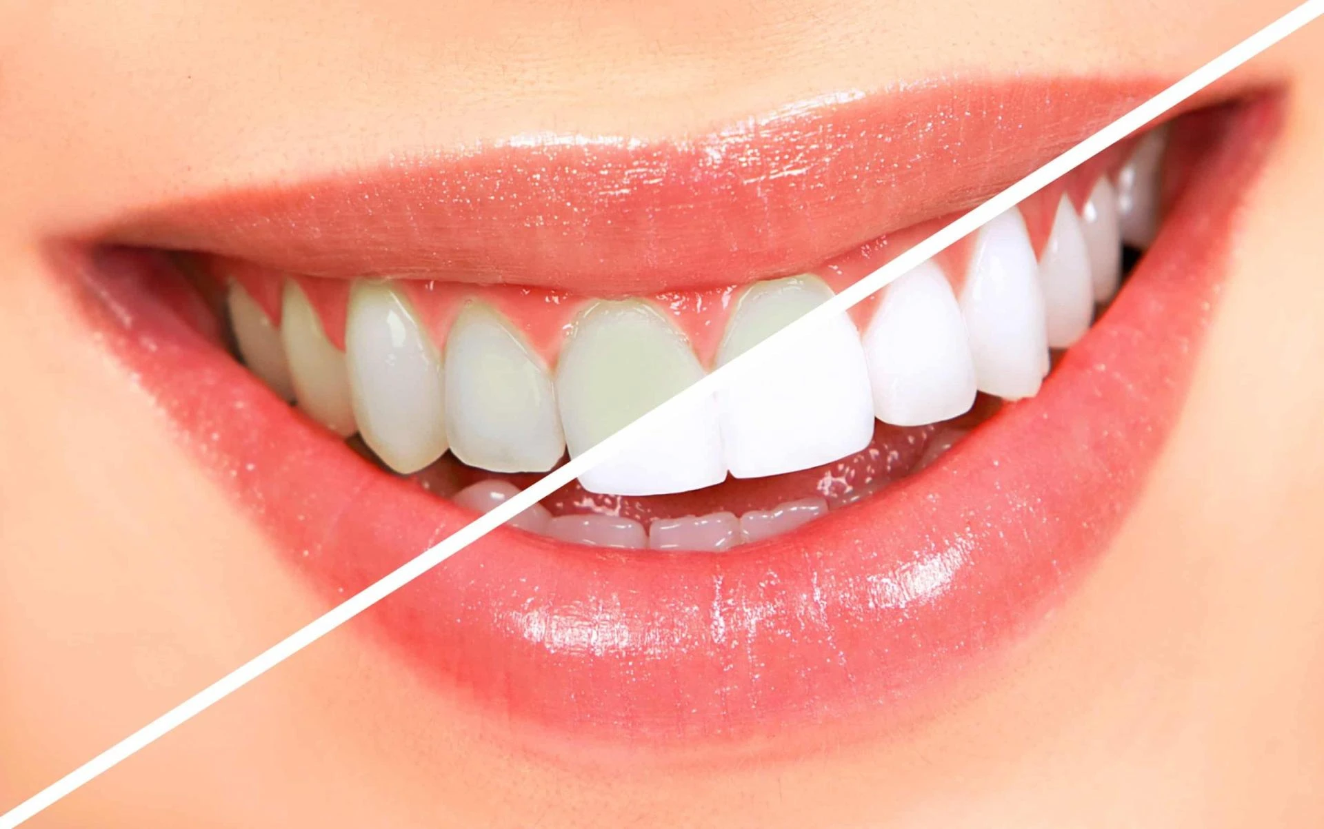 Looking For Teeth Whitening Services In Windsor? Here's What You Need To Know