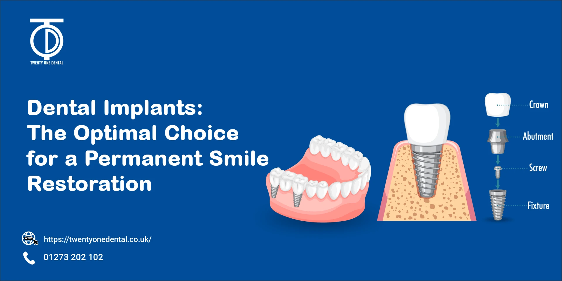 Achieving Lasting Smile Transformation | TwentyOne Dental