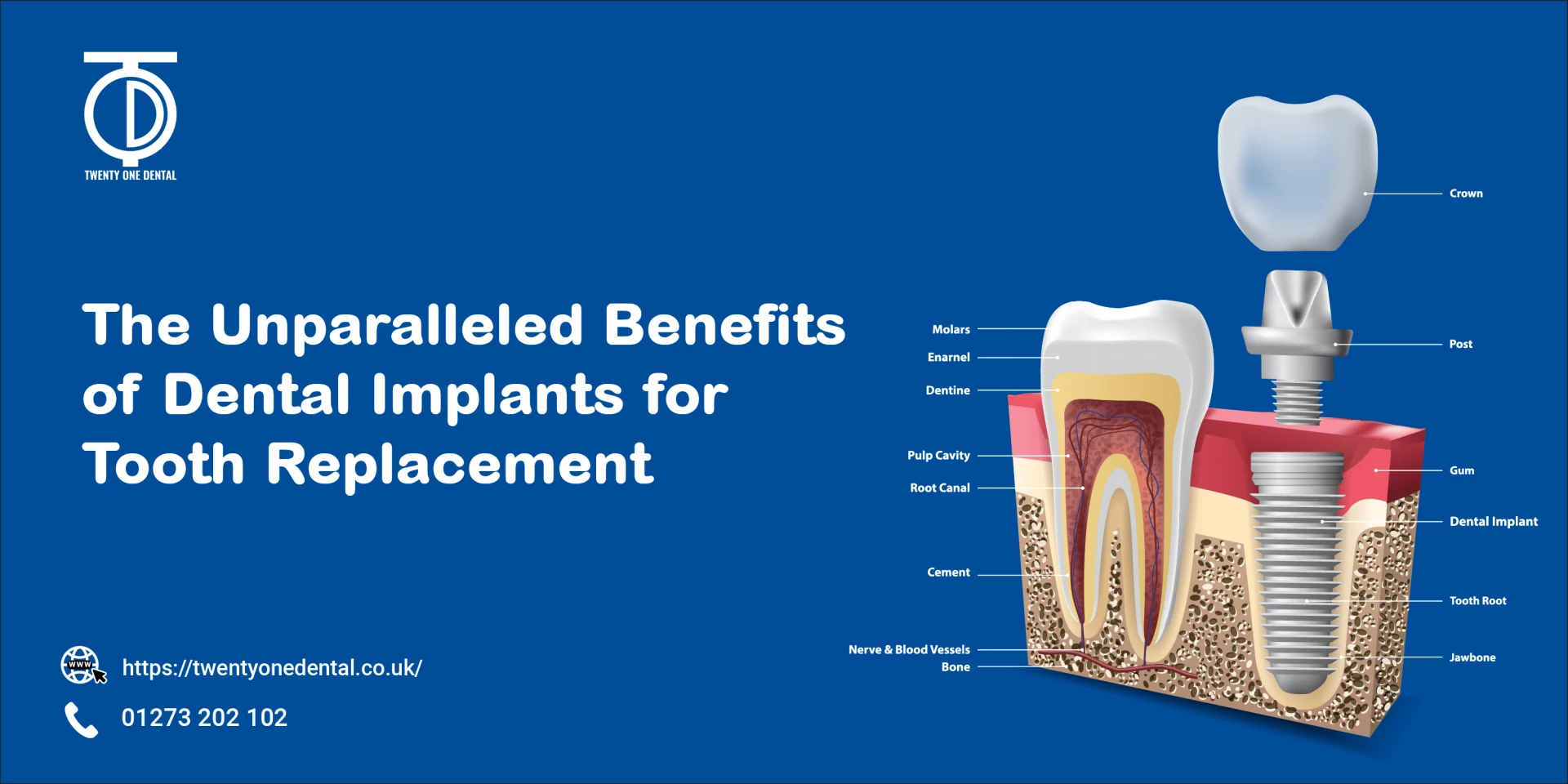 The Unparalleled Benefits of Dental Implants for Tooth Replacement | TwentyOne Dental