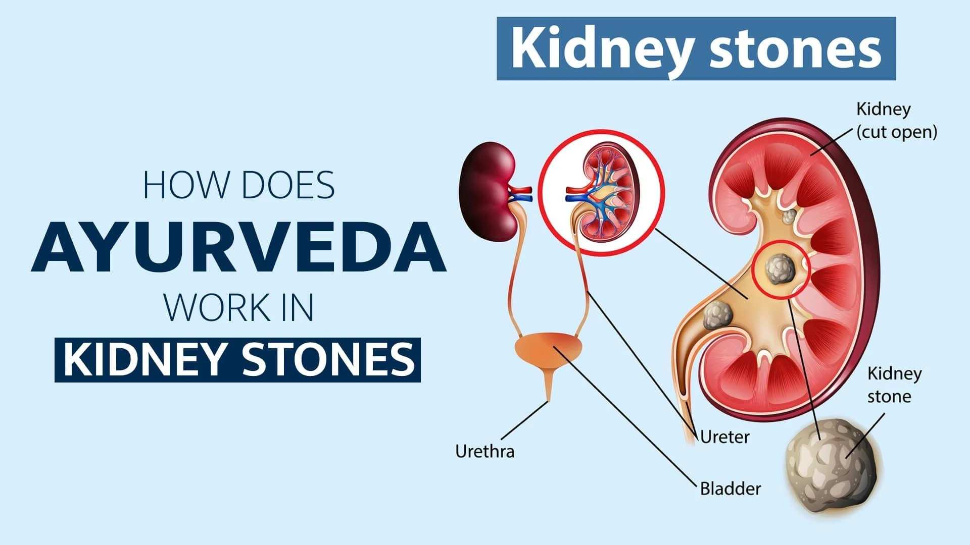 How does Ayurveda works in Kidney Stones