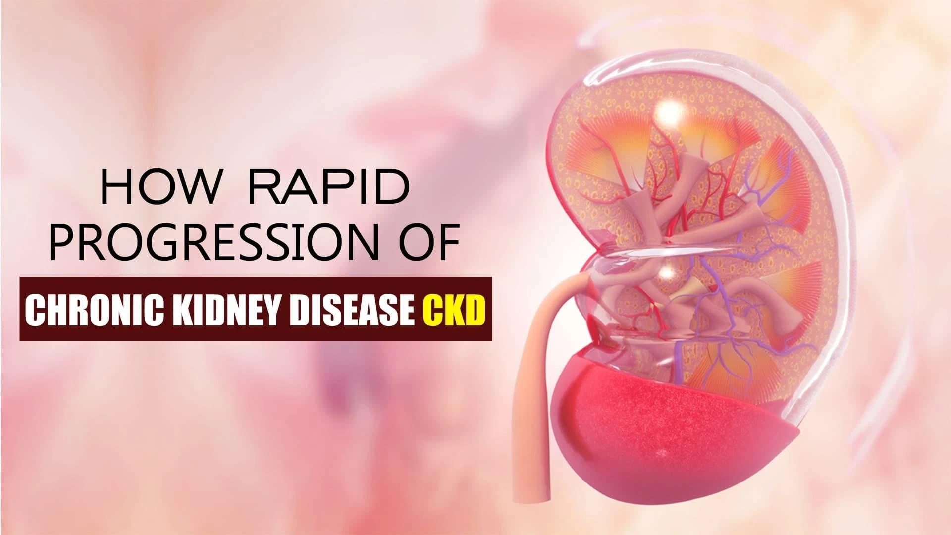 How Rapid Progression of Chronic Kidney Disease CKD?