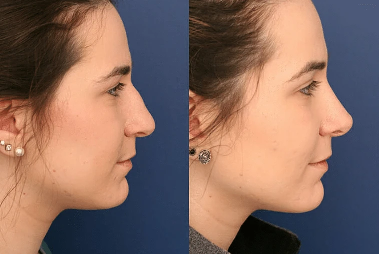 Common Steps For A Rhinoplasty Procedure