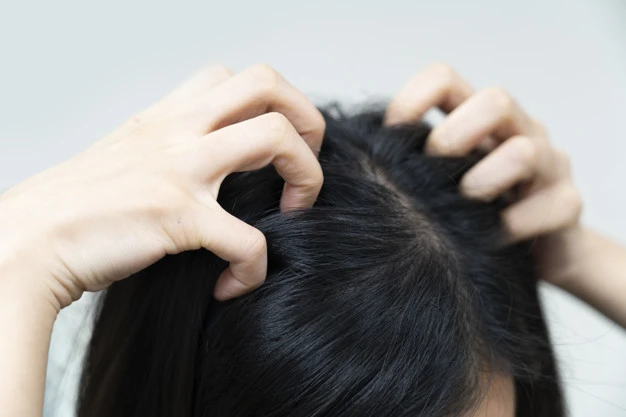 How to Take Care of Hair With Dandruff