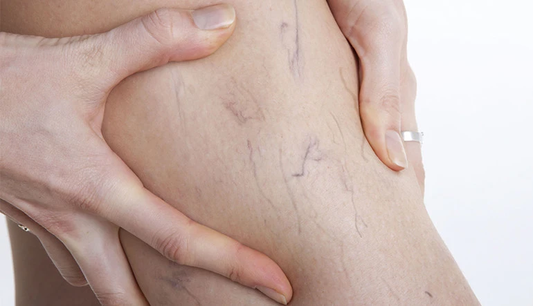 How To Select The Ideal Vein Specialist For Your Vein Issue?