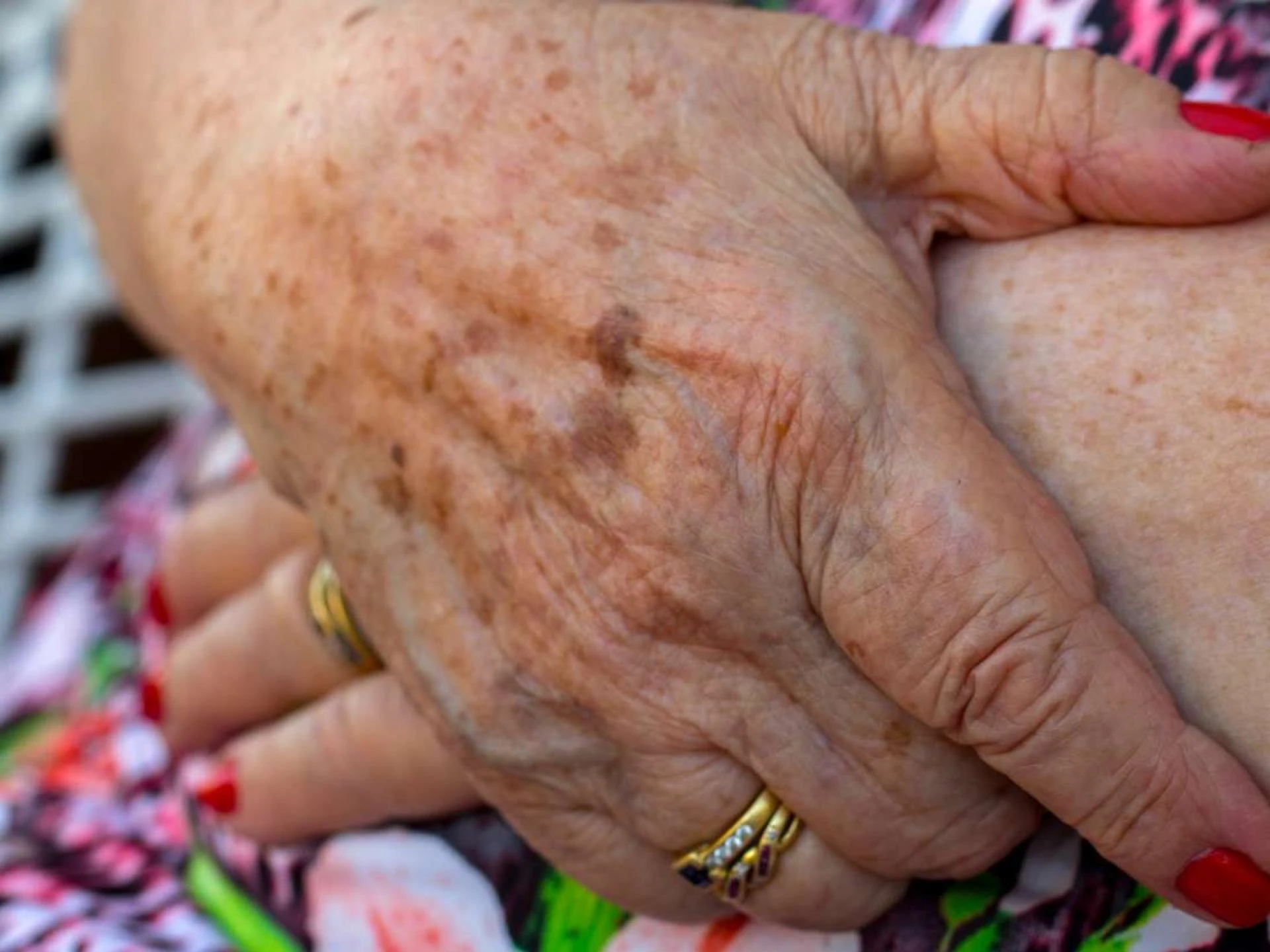 How A Spider Vein Doctor Can Help You Obtain A Vein Disease-Free Life?