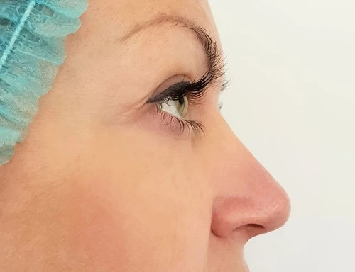When it comes to non-surgical nose jobs for wide noses, how should I prepare myself?