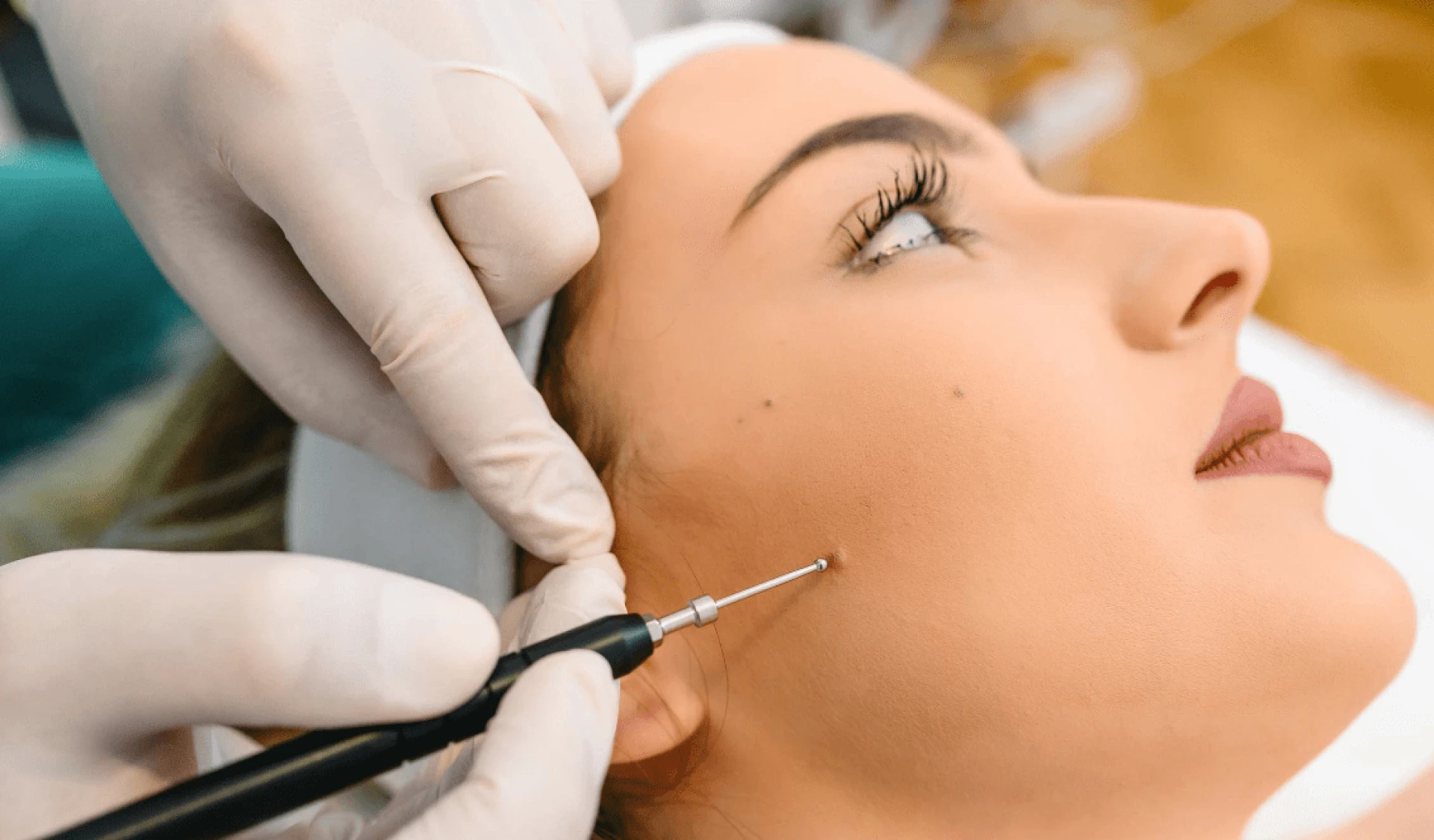 Can Lasers Remove Moles?