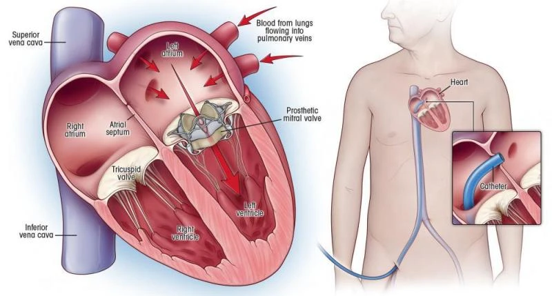 Treatment of severe mitral regurgitation using transcatheter mitral valve repair and replacement