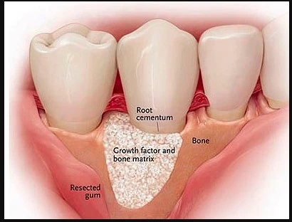 "Emerging Technologies Shaping the Future of Dental Bone Graft and Substitutes"