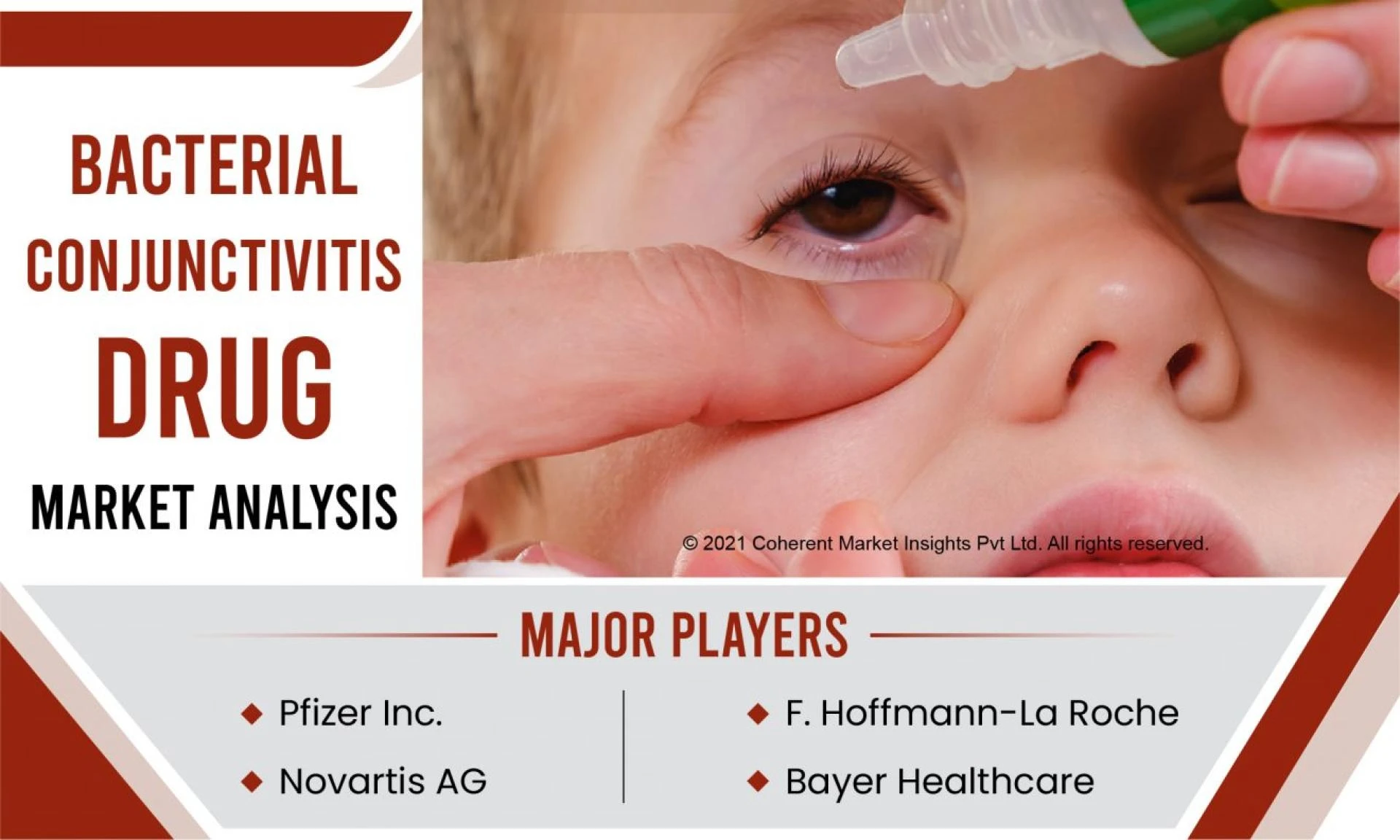 "Bacterial Conjunctivitis Treatment Market: A Comprehensive Overview"