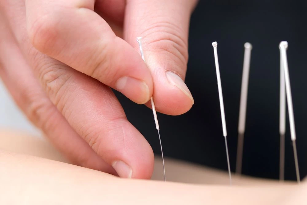 What are the different types of acupuncture?