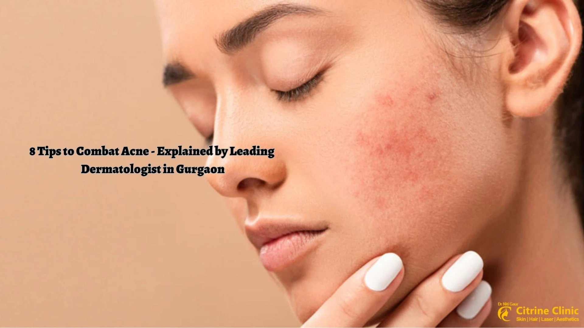 8 Tips to Combat Acne - Explained by Leading Dermatologist in Gurgaon