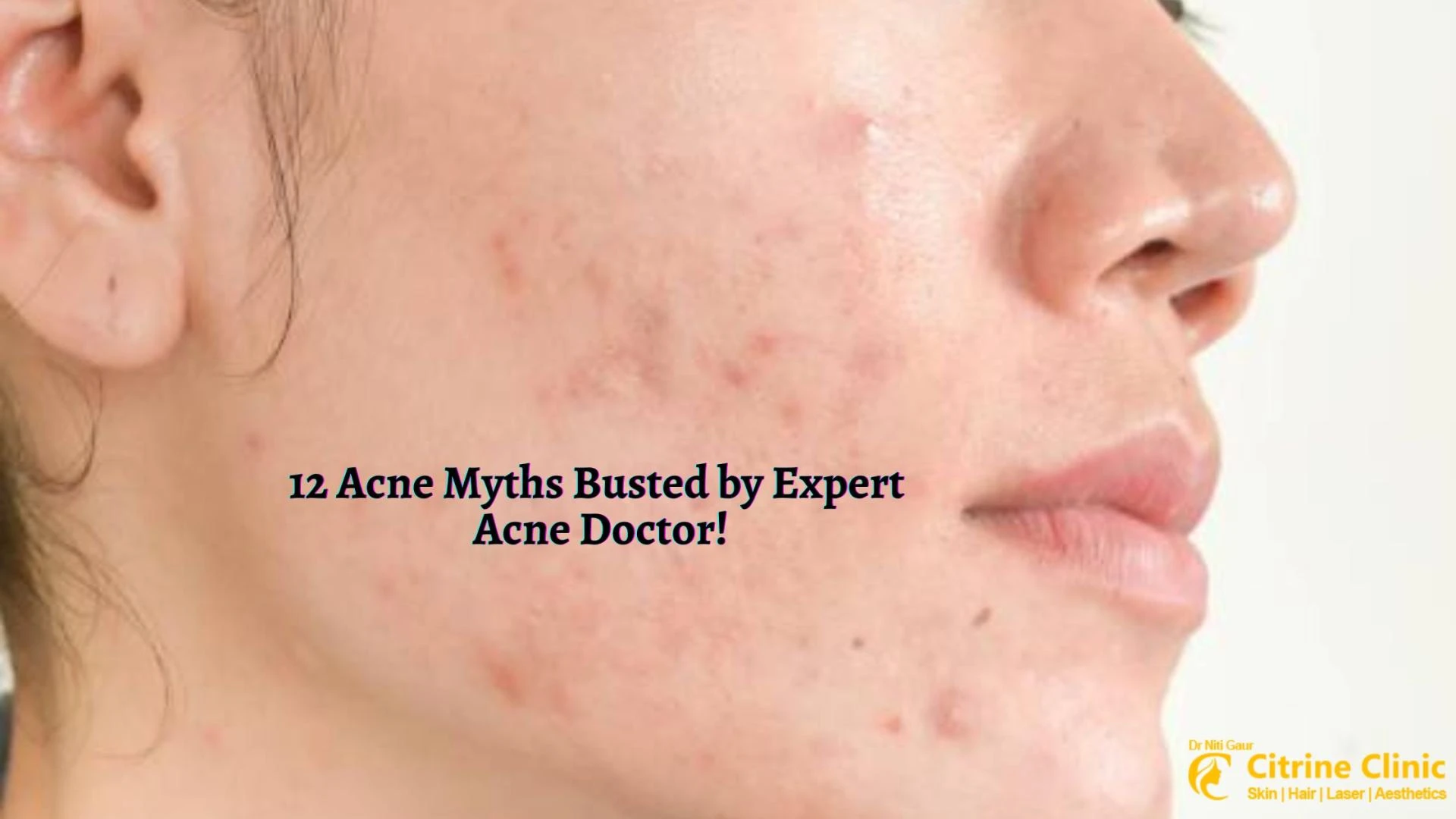 12 Acne Myths Busted by Expert Acne Doctor