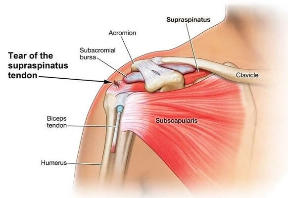 Rotator Cuff Surgery Delhi - Delhi Arthroscopy