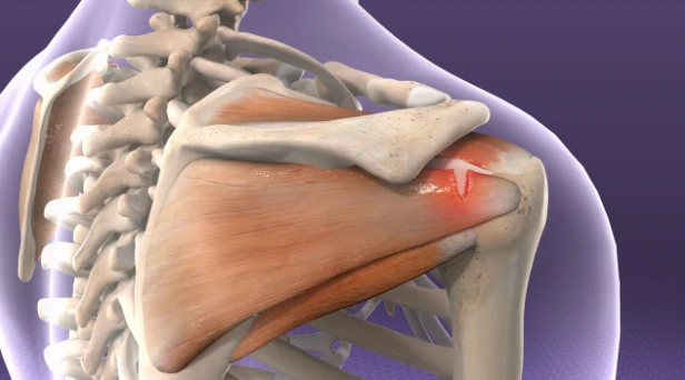 How to Maintain Your Shoulder Joint’s Health and Happiness by Dr Shekhar Srivastav
