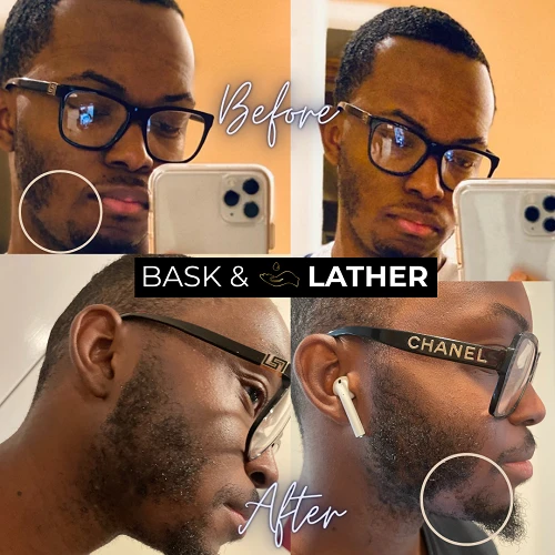 4 Ways to Address Male Pattern Baldness