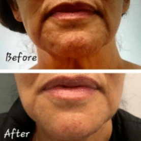 Cheek Fillers: Everything You Need to Know