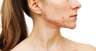Are you tired of your skin problems? Consult with the Best Dermatologists in Bangalore