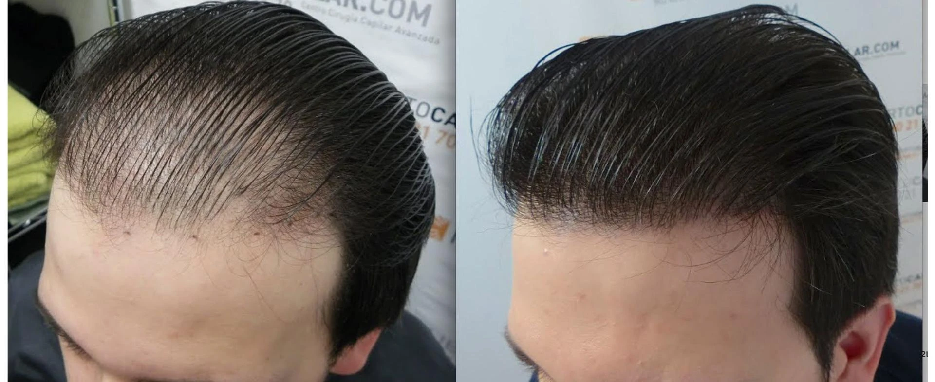 Hair Transplants Cost