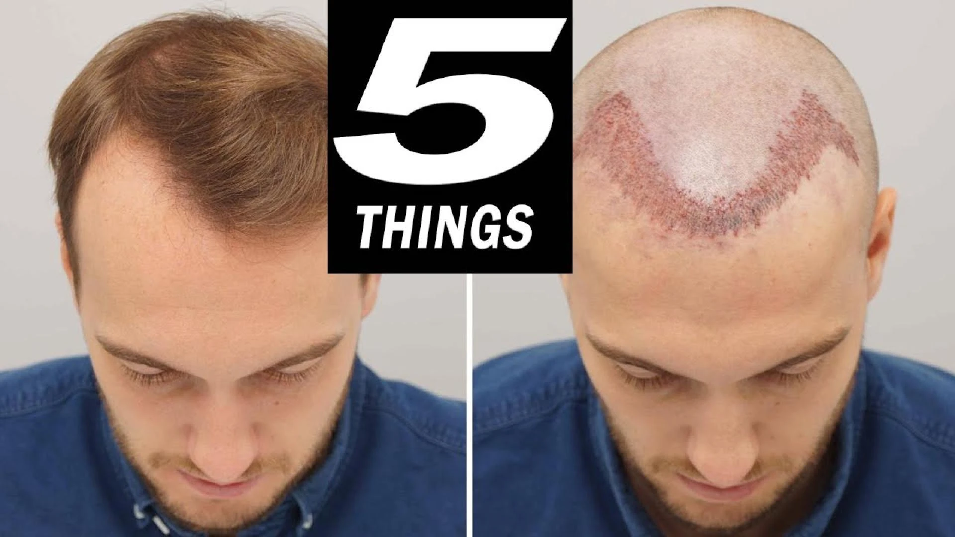 After Hair Transplant Care In Hair Restoration Surgery