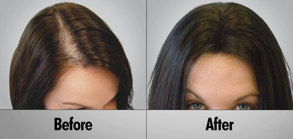Is A Female Hair Transplant For You?