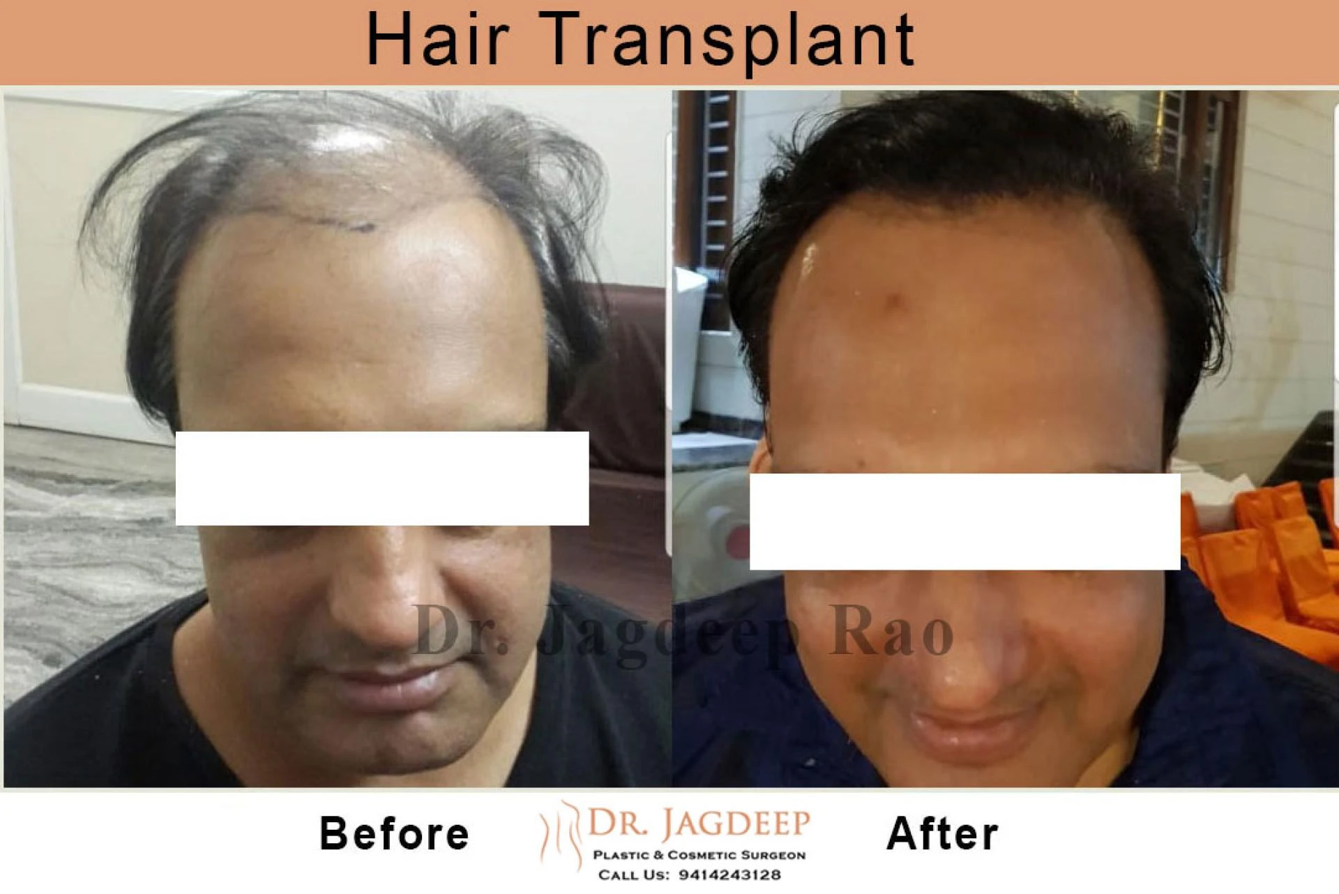 Types of Hair Transplant Treatment