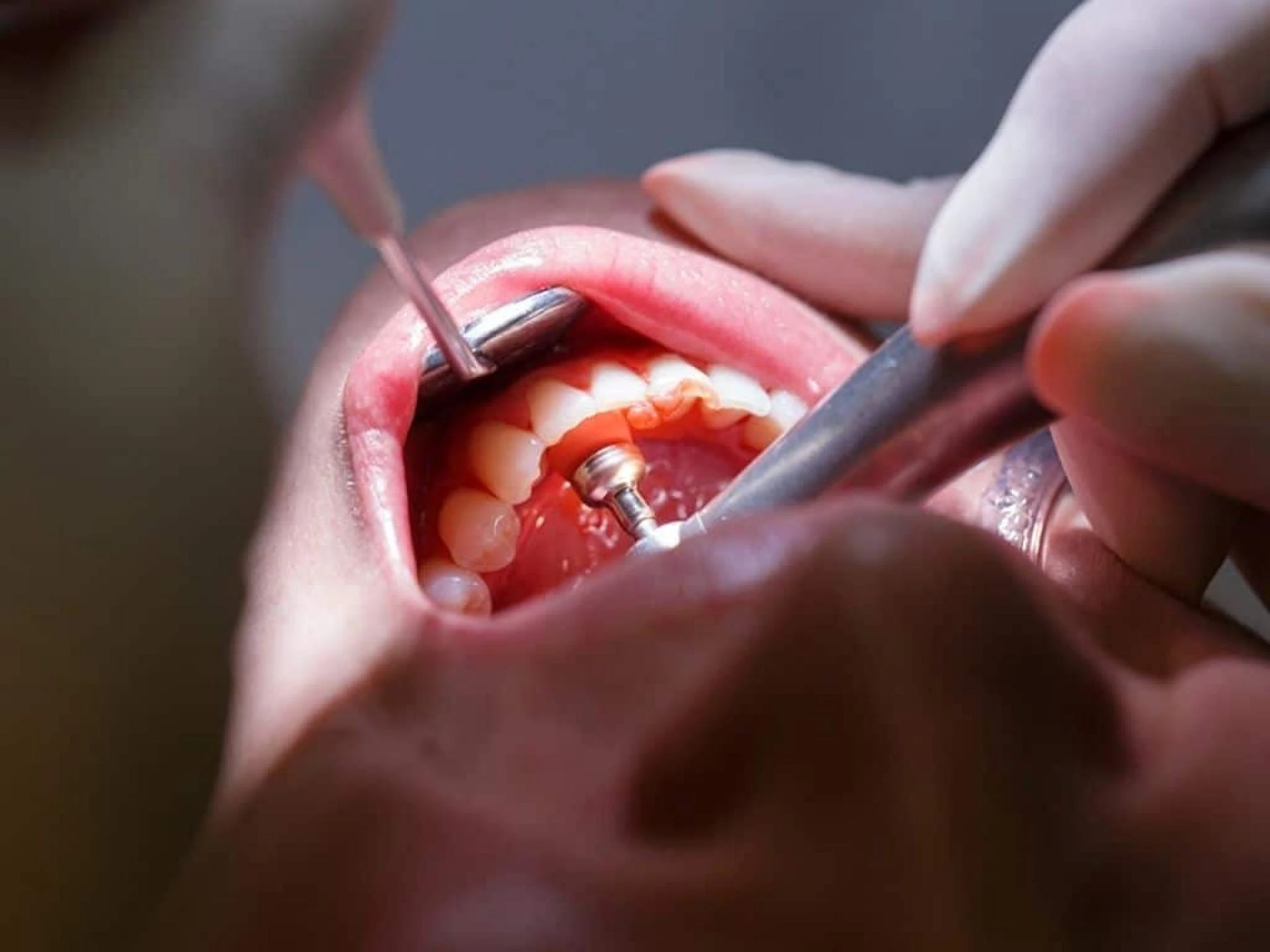 Should I go To The Dentist for swollen gums?
