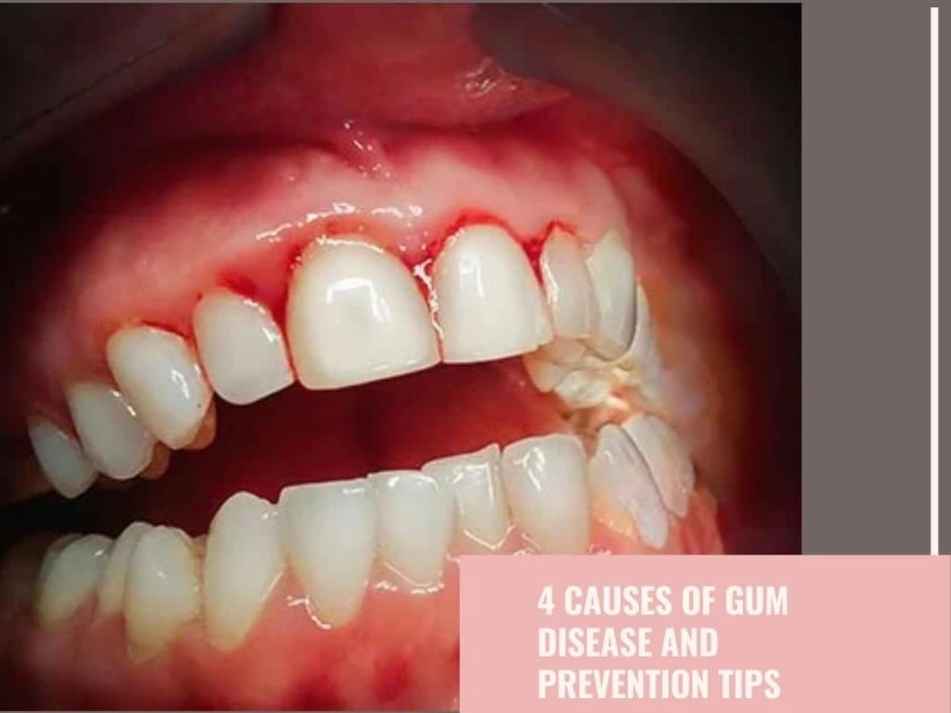 4 Causes Of Gum Disease and Prevention Tips