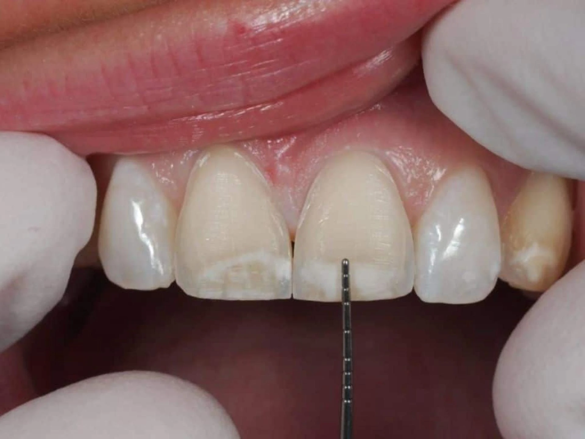 What is The Procedure of Dental Veneers in Berwick?